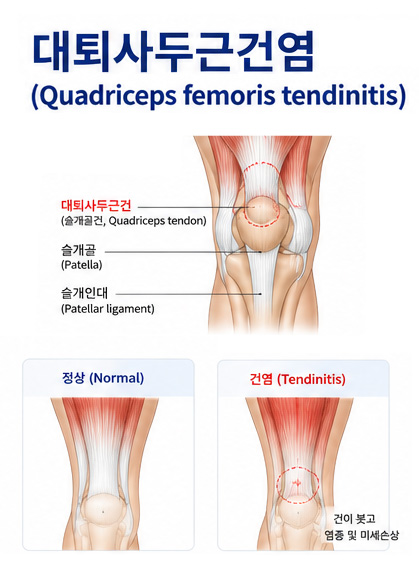 대퇴사두근건염 정상 및 건염 비교 이미지