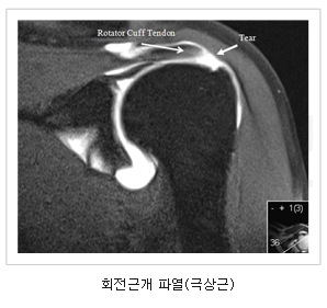 회전근개 파열(극상근)