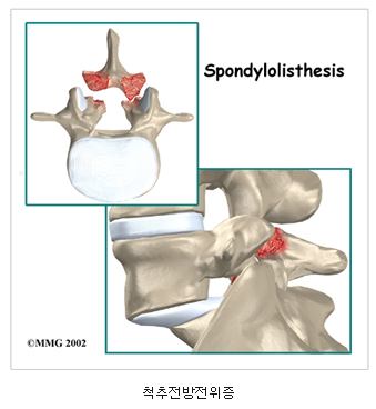 척추전방전위증