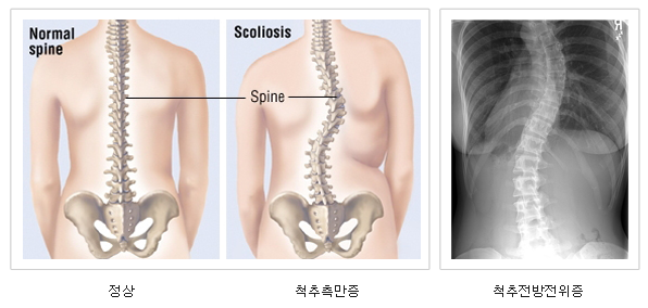 척추측만증정상/척추측만증/척추측만증 x-ray