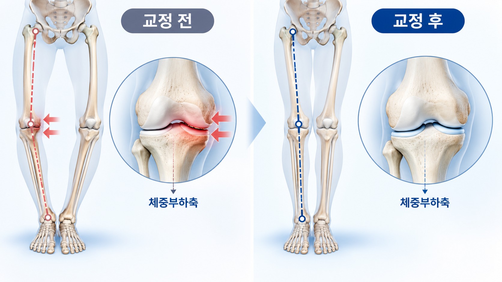 O자형 하지 정렬과 근위경골절골술 후 하중 분산 원리를 비교한 의료정보 일러스트