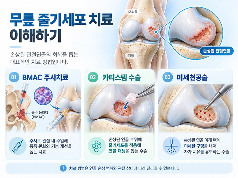 BMAC 주사치료와 카티스템 연골 재생 수술의 적용 방식 및 치료 목적 차이