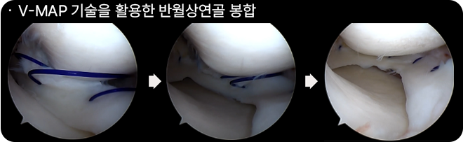 V-MAP 기술을 활용한 반월상연골 봉합 수술 과정