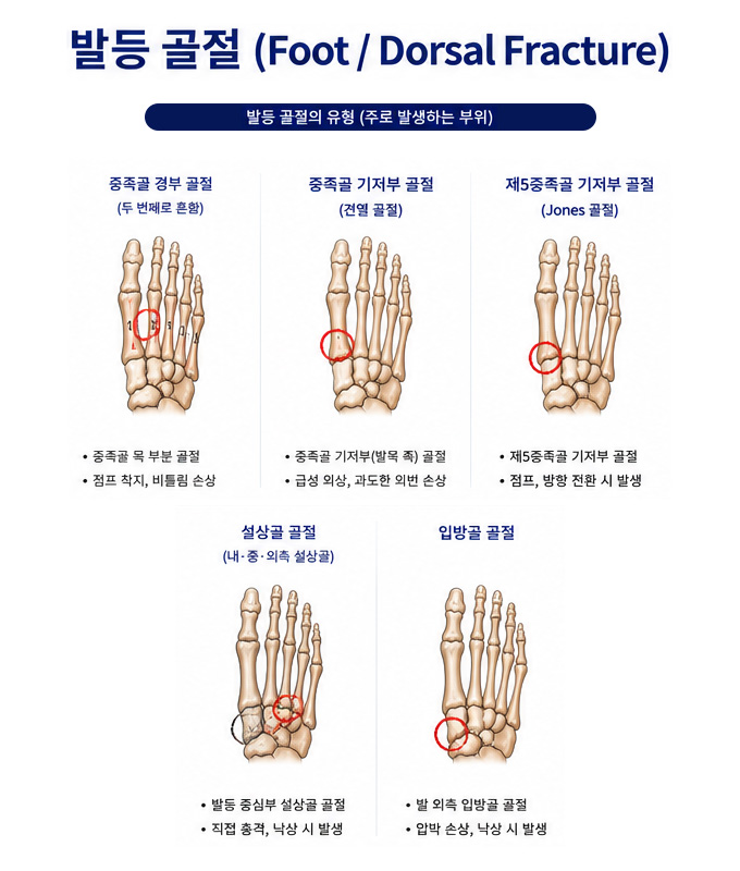 발등 골절의 유형 및 주 발생 부위 설명 이미지