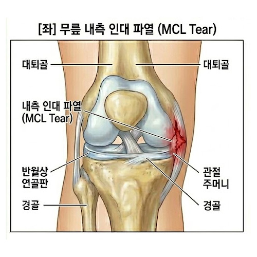무릎 내측 인대 파열 (MCL Tear)