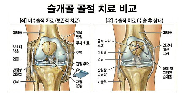 슬개골 골절 비수술적 치료, 수술적 치료 비교