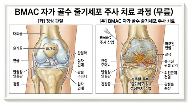BMAC 자가 골수 줄기세포 주사 치료 과정