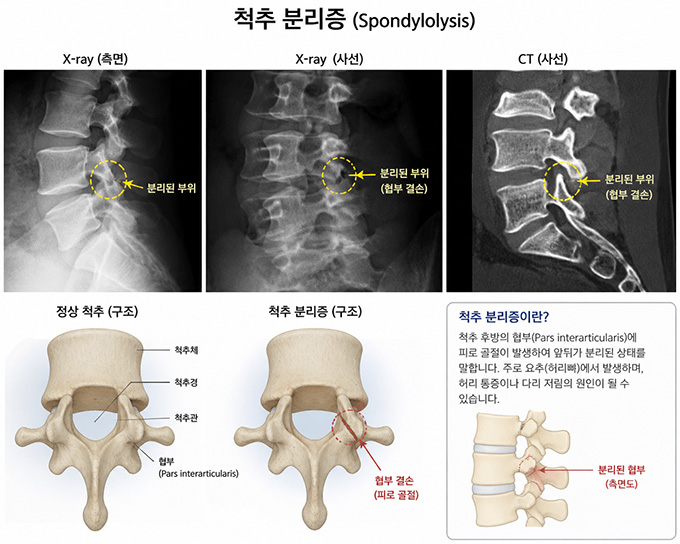 척추 분리증 구조 및 X-ray 영상
