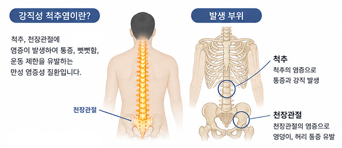 강직성 척추염 설명 이미지