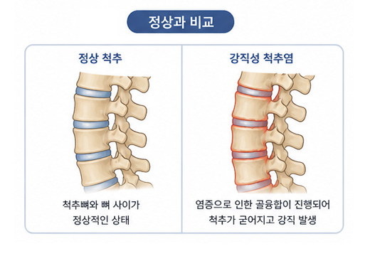 정상 척추 강직성 척추염 비교 이미지