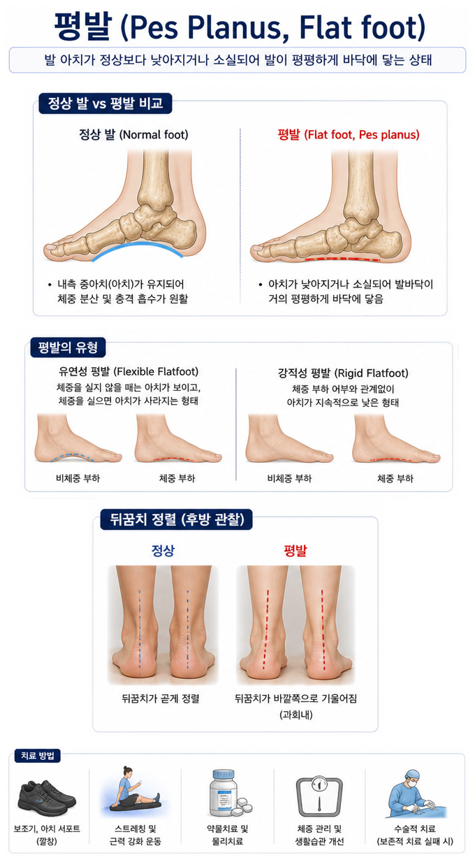 평발 증상 및 유형 치료 방법 설명 이미지