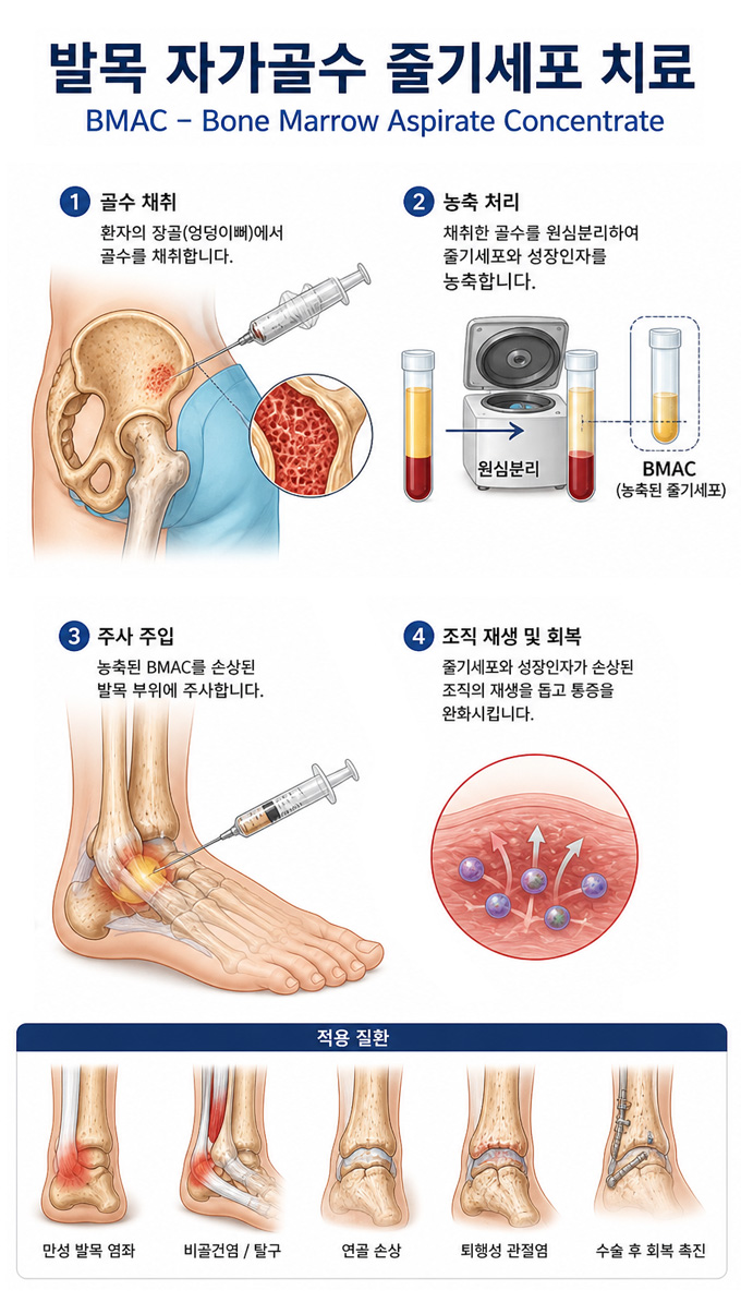 발목 자가골수 줄기세포 치료 과정 설명 이미지