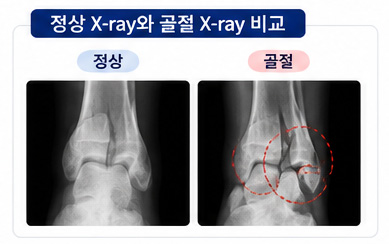 정상 X-rady 와 골절 X-ray 비교 이미지