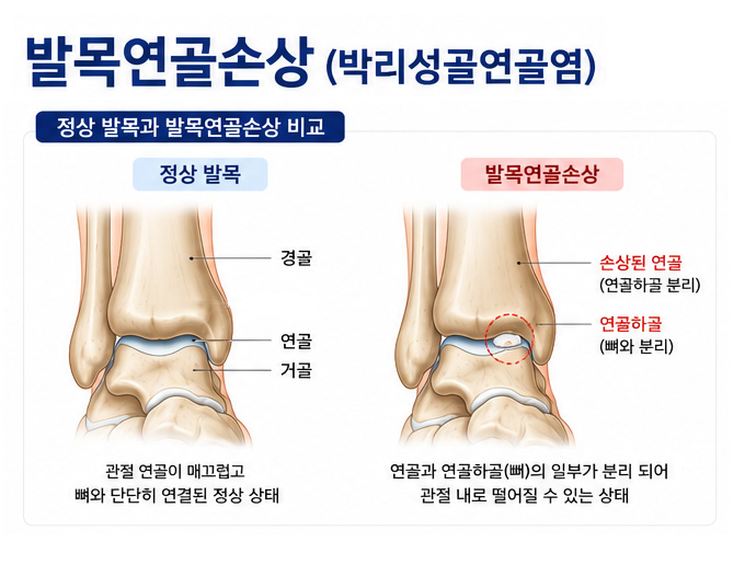 정상 발목과 발목연골손상 비교 이미지